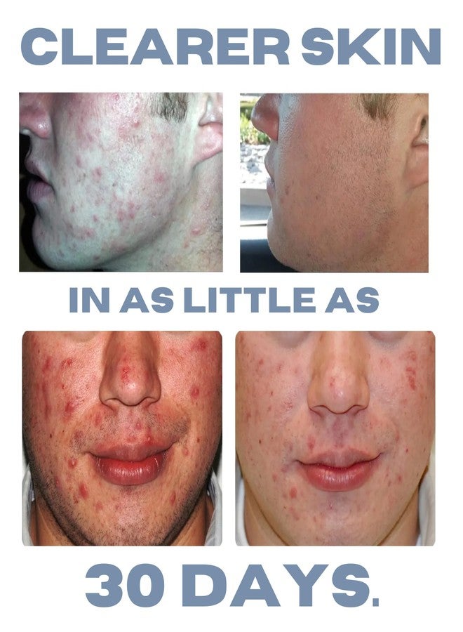 كليروجين مجموعة علاج حب الشباب، مجموعة علاج حب الشباب، العناية بالبشرة لعلاج حب الشباب، مجموعة العناية بالبشرة المعرضة لحب الشباب، مجموعة فاخرة طبيعية مضادة لهرمون ديهدروتستوستيرون، تركيبة أصلية، مجموعة بنزويل بيروكسيد من 3 قطع، تكفي لمدة شهر واحد - Image 3